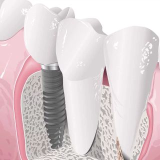 Impianti dentali: l'impatto dello stile di vita sulla durata
