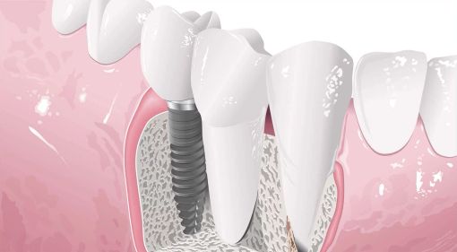 Impianti dentali: l'impatto dello stile di vita sulla durata