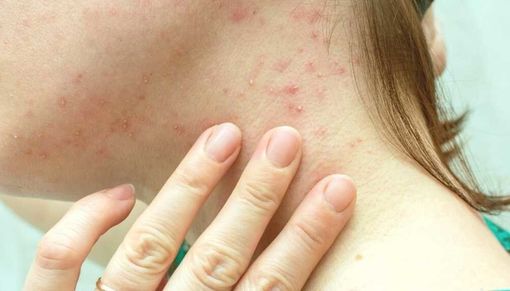 Primo caso di vaiolo delle scimmie in Canton Ticino