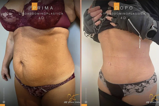 Intervento addominoplastica