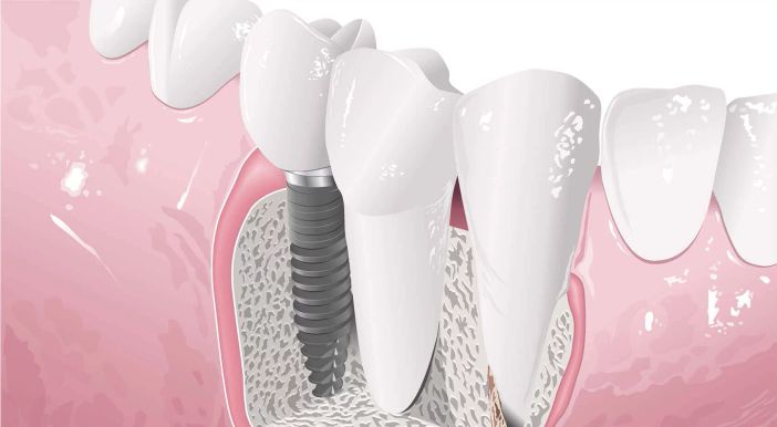 Impianti dentali: l'impatto dello stile di vita sulla durata Impianti dentali: l'impatto dello stile di vita sulla durata