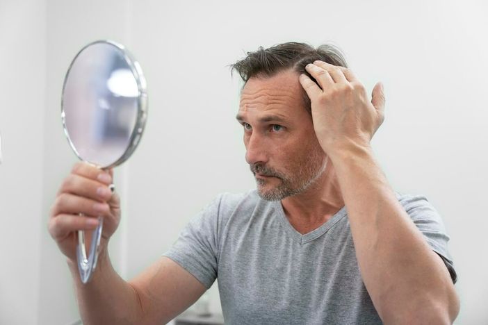 Stempiatura fisiologica o alopecia androgenetica: cosa distingue le due condizioni Stempiatura fisiologica o alopecia androgenetica: cosa distingue le due condizioni