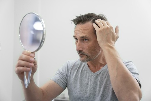 Stempiatura fisiologica o alopecia androgenetica: cosa distingue le due condizion