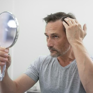 Stempiatura fisiologica o alopecia androgenetica: cosa distingue le due condizioni