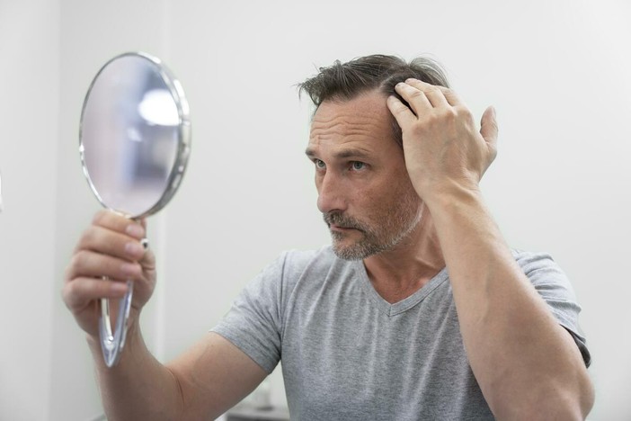 Stempiatura fisiologica o alopecia androgenetica: cosa distingue le due condizion