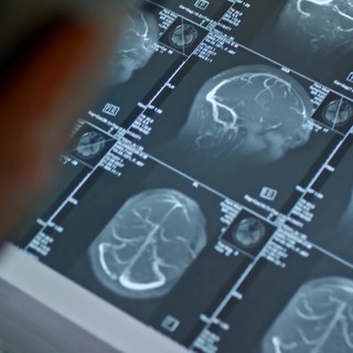 Fenilchetonuria, 'screening neonatale evita danni neurologici ma serve continuità assistenziale'
