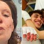 Crans-Montana, oggi dimessi due ragazzi. Eleonora Palmieri mostra le ustioni sui social