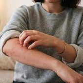 Malattia della pioggia, perché se ne parla: cos'è e sintomi