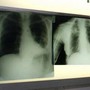 Cancro polmone, con nuova combinazione malattia sotto controllo più a lungo Cancro polmone, con nuova combinazione malattia sotto controllo più a lungo