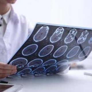 Sin: "Diagnosi più rapide e farmaci innovativi cambiano decorso sclerosi multipla"