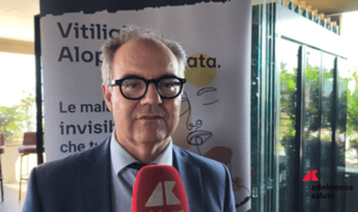 Costanzo (Sidemast): "Upadacitinib blocca cellule infiammatorie in vitiligine e alopecia areata"