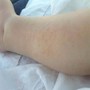 Dermatite atopica, Aifa estende rimborso di upadacitinib dai 12 anni di età Dermatite atopica, Aifa estende rimborso di upadacitinib dai 12 anni di età
