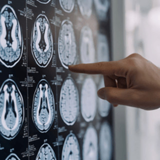 Tumori: glioma, Fda riconosce come farmaco orfano l'isotopo rame-64 sviluppato nelle Marche