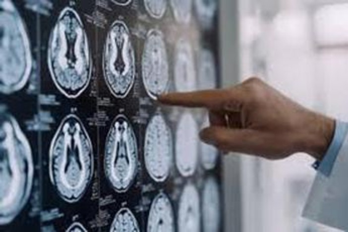 Centro Dbs Pavia, 100 interventi di neurostimolazione profonda per Parkinson