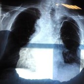 Cancro polmone, nuova terapia orale riduce del 44% il rischio di morte Cancro polmone, nuova terapia orale riduce del 44% il rischio di morte