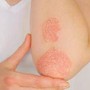 Psoriasi, dati positivi per inibitore orale di Tyk2 di nuova generazione