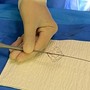 Fibrillazione atriale, Aou Marche: "Prima volta in Italia ablazione con catetere a campo pulsato"
