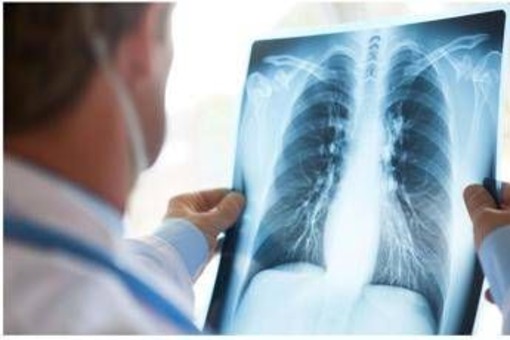 Cancro polmone Egfr-mutato, studio fase 3 Adaura: "Il 79% dei pazienti vivo a 8 anni con Osimertinib" Cancro polmone Egfr-mutato, studio fase 3 Adaura: "Il 79% dei pazienti vivo a 8 anni con Osimertinib"