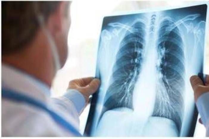 Cancro polmone Egfr-mutato, studio fase 3 Adaura: "Il 79% dei pazienti vivo a 8 anni con Osimertinib" Cancro polmone Egfr-mutato, studio fase 3 Adaura: "Il 79% dei pazienti vivo a 8 anni con Osimertinib"