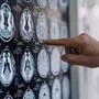 Centro Dbs Pavia, 100 interventi di neurostimolazione profonda per Parkinson